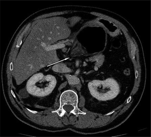 Axial section demonstrating the hernia through the foramen of Winslow.
