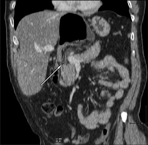 Coronal slice showing herniation of right colon through the foramen of Winslow.