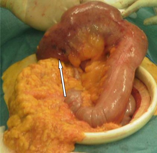 The herniated segment after reduction, with areas of necrosis.