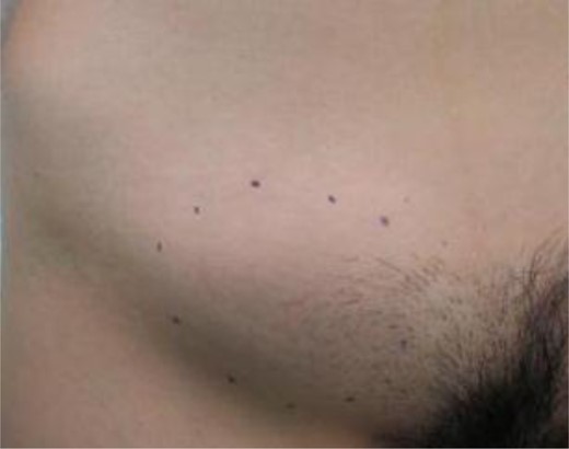 A 5-cm mass was confirmed over the right inguinal ligament by physical examination.