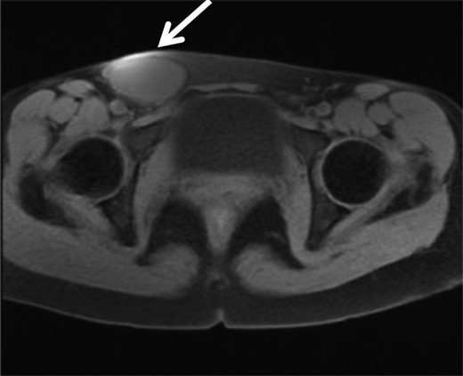 MRI showed a high intensity tumor in T1WI which suggest bleeding in the tumor, in the right inguinal region.