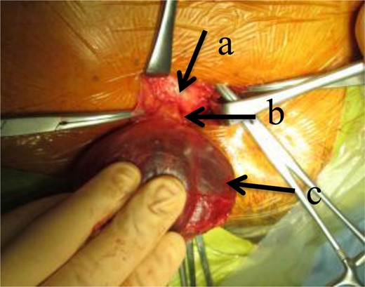 Surgical findings; a dark red tumor was found below the inguinal ligament (arrow a), and a string structure was found through the femoral ring (arrow b), which connected the cyst-like tumor (arrow c) with the peritoneum.