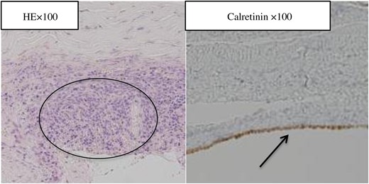 Hematoxylin and eosin-stained section showing a focus of lined mesothelial cells at the wall of the cyst with degeneration, inflammation, hemorrhage, formation of hyperplastic collagen fiber, hemosiderosis and endometrial stroma. The immunohistochemical staining with anti-Calretinin antibody demonstrating positive reaction in the areas where lined cells are of the mesothelial origin.