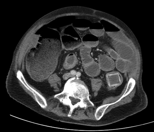 Large gallstone impacted in the descending colon-sigmoid junction, causing large bowel obstruction proximally.