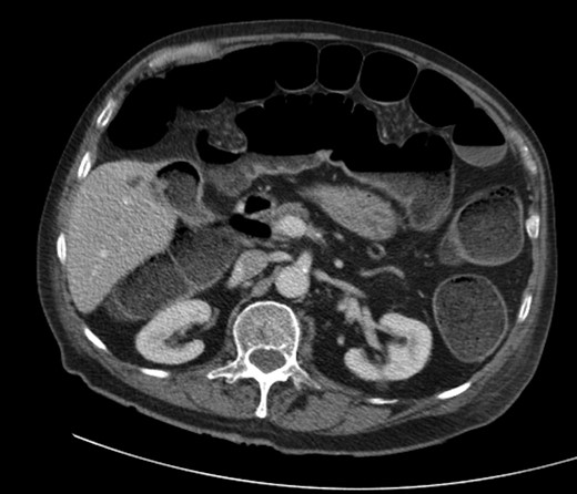 Cholecysto-colic fistula, with a thick-walled, dilated, gallbladder.