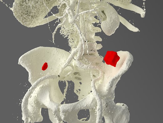 CT reconstruction showing the impacted gallstone and a smaller incidental gallstone in the caecum.