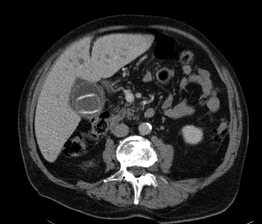 The offending gallstone as an incidental finding 3 years previously.
