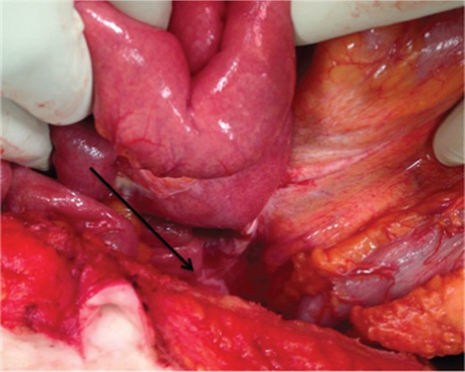 Intra-operative photo: dilated lymphatics at the base of mesentery (arrow).