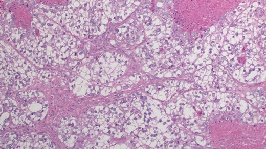 Microscopic examination reveals tumor cells with ample clear cytoplasm, distinct cell borders and pleomorphic nuclear features (×20).