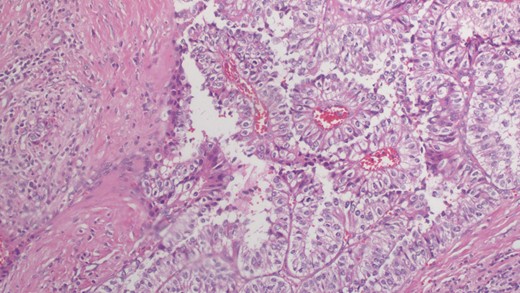 Microscopic examination reveals well-formed angular and papillary epithelial tumor cells with ample clear cytoplasm (×20).