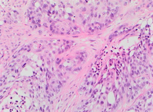 TCC at base of bladder.