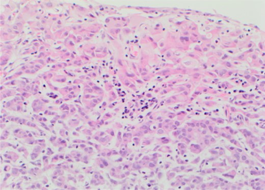 Metastatic lobular carcinoma of the breast identified on right wall of bladder.