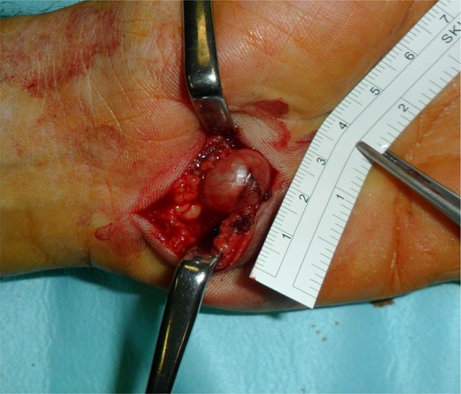 A curvilinear incision revealed an ulnar aneurysm 1.5 cm in length.