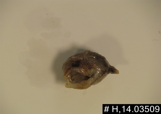 Microscopy revealed an organizing thrombus. The intima was focally hyalinised and the media focally thinned, containing scattered neutrophils.