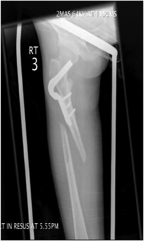 AP-XR demonstrating a peri-prosthetic fracture of the right femur below the blade plate. Blade plate noted to be breaching femoral neck.
