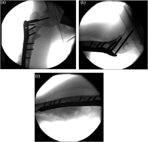 Image intensifier intra-operative AP highlighting 10 hole PHILOS applied with near anatomical reduction (a–c).