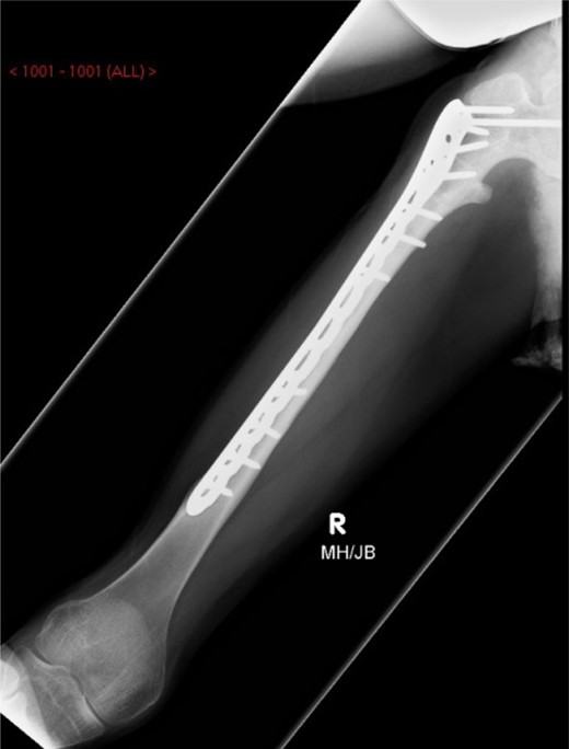 AP-XR demonstrating radiographic union at 11 months with 10 hole PHILOS insitu.