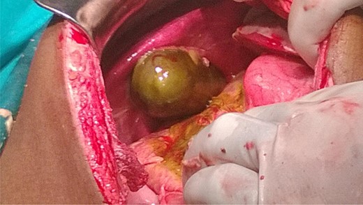 Gangrenous gall bladder with inflamed and oedematous surrounding structures.