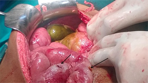 Showing gangrenous gall bladder and two ileal perforations (arrows marked).
