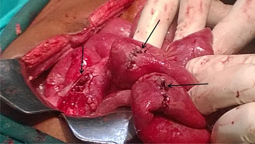 Three ileal perforations (arrows marked), two repaired and one to be repaired.