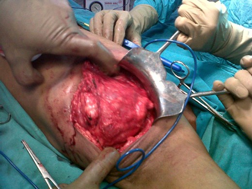 Intra-operative picture showing encapsulated mass in the axilla.