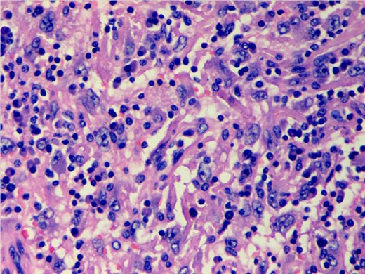 Photomicrograph showing scattered discohesive large cells with pleomorphic nuclei (H&E stain; ×400).