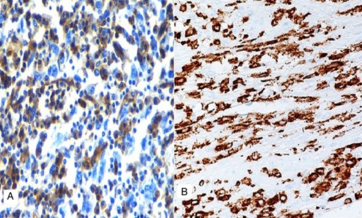 Photomicrograph showing negative immunostaining with CD68 (A) and positive stain for CD163 (B).