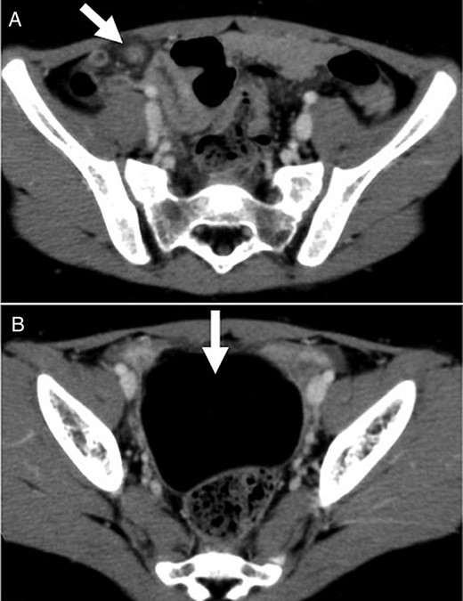 Contrast-enhanced CT scan showed (A) torsion of the omentum, which was seen as linear folds of omental tissue in a concentric pattern that extended from the level of the transverse colon to the right lower abdomen; and (B) a pelvic mass of 6 cm in diameter with the same uniform radiodensity as fatty tissue.