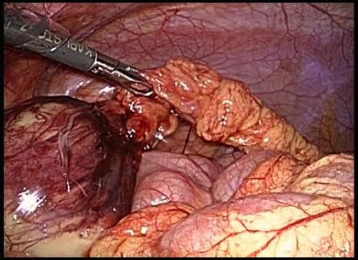 Laparoscopy revealed a tumor at the right lower border of the greater omentum with a smooth surface. Laparoscopic resection of the necrotic omentum was performed using an ultrasonic coagulation device.