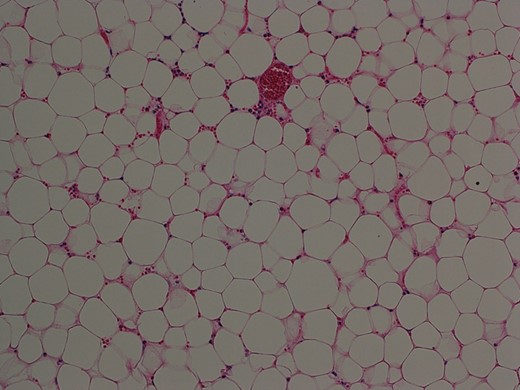 Histopathological examination of the resected specimen showed that the tumor was composed of mature fat cells (hematoxylin and eosin, original object magnification ×10).