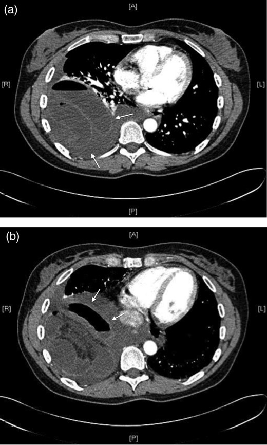 (a) and (b) Large right-sided diaphragmatic hernia with obstructed bowel (white arrows) evident on CTPA.