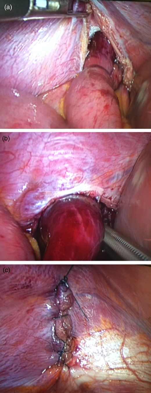 Laparoscopic images of diaphragmatic hernia repair. Images demonstrate (a) right hemidiaphragmatic defect containing a loop of small bowel the distal end of which is ischaemic, (b) extraction of the bowel loop from the diaphragmatic defect and (c) laparoscopic repair of the defect with 0 PDS.