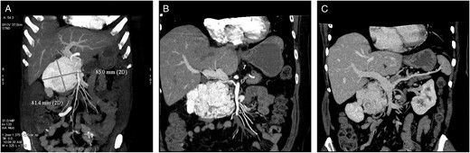 Cross-sectional CT imaging. (A) Hypervascularized tumour with early venous filling in the arterial phase of CT. (B) Variant subtle right hepatic artery originating from SMA, passing between the dilated PV and draining veins of a paraganglioma. (C) Isolated dilation of the PV with surprisingly gracile splenic vein without any spleen enlargement.