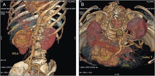 (A and B) CT volume rendering images with dilated PV and an early contrast filling of dilated peritumoral veins.