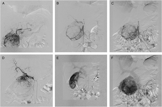 DSA. (A) GDA supplying the upper portion of the paraganglioma. (B) SMA—tumour blood supply via both IPDA and replaced RHA. (C) Selective IPDA angiography. (D) Selective angiography via replaced RHA. (E) Complementary tumour blood supply via capsular branch of RRA draining into the portal system. (F) PV dilation in the venous phase of angiography.