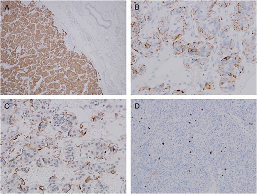 Histopathological examination of resected specimen with different stains and sites. (A) Synaptophysin expression (100×). (B) Chromogranin expression (×400). (C) Sustentacular cells S100 immunostain (×400). (D) Low proliferation activity Ki-67 stain (×200).