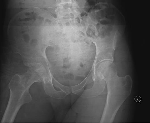 Pelvic X-ray showing joint space narrowing and collapse of the right hip.