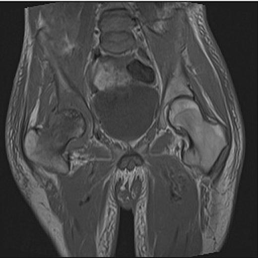 MRI showing avascular necrosis of the right femoral head.