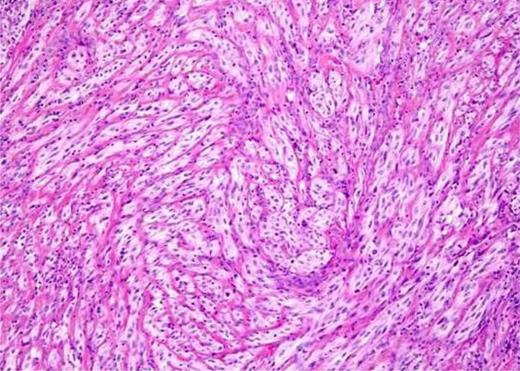 Myoepithelial cells stained and enhanced, negative for smooth muscle actin, desmin and caldesmon.