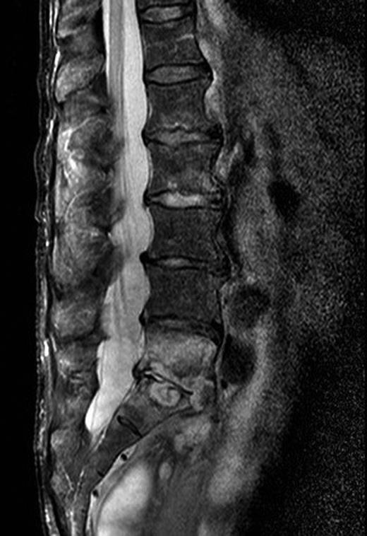 MRI of the spine with vertebral discitis L5/S1.