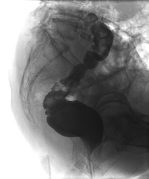 Barium enema without fistula at infection site.