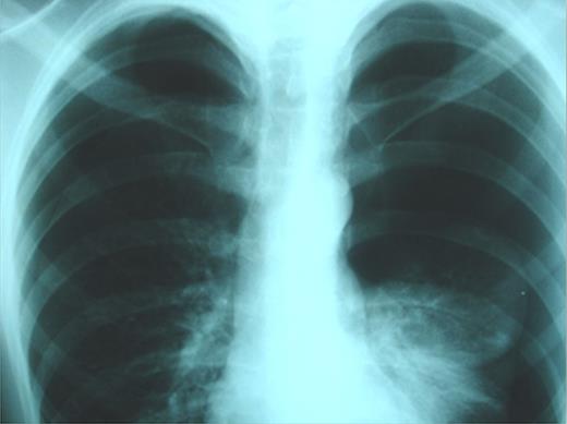 Plain chest X-rays on admission revealing bilateral pneumothorax.