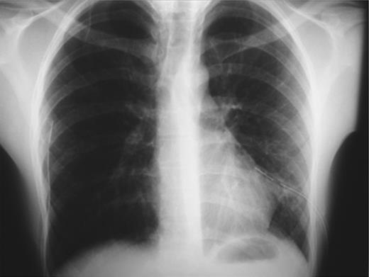 Complete bilateral lung expansion after insertion of chest tubes.