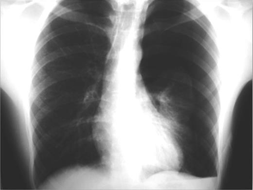 Recurrence of pneumothorax on the left side after removing the chest tube.