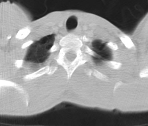 CT image showing bilateral blebs on the apices of the upper lobes.