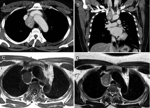 Contrast-enhanced CT revealed a heterogeneous tumor measuring 4 cm in the middle mediastinum (A and B). MRI showed a tumor demonstrating the low intensity both on the T1-weighted image (C) and the T2-weighted image (D).