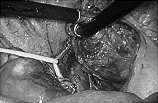 Intraoperative findings. Dissecting the tumor from surrounding structures. The vagus nerve was taped.
