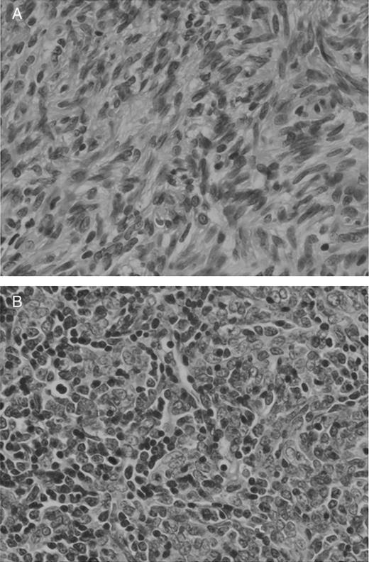 Pathological findings. Spindle cell proliferation (A) and lymphocyte infiltration (B) (hematoxylin eosin stain ×400).