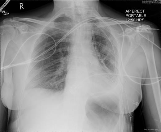 Chest radiography immediately after left upper lobectomy demonstrates good lower lobe expansion.