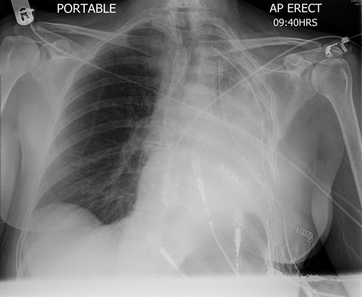 Chest radiography on the first post-operative day shows left-sided consolidation with normal left hemidiaphragm position.